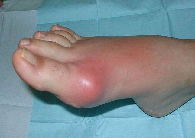 Clinical picture of arthritis of the feet - swelling and inflammation
