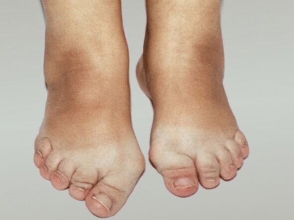 Osteoarthritis of the foot with severe deformity of the toes