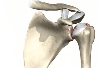 Shoulder joint affected by arthrosis