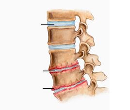 Osteochondria