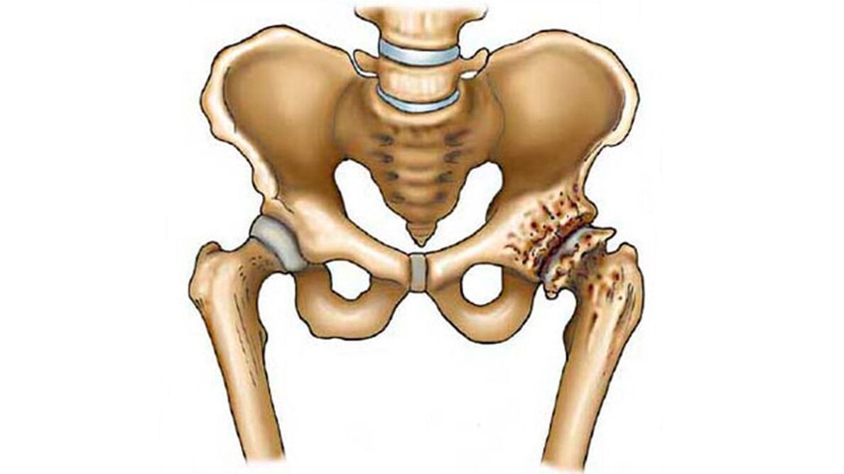 damage to the hip joint in the presence of arthropathy