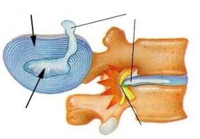 destruction of the annulus fibrosus in cervical osteochondrosis