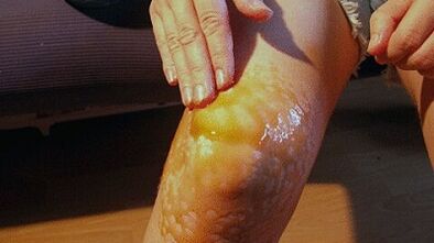 Garbage to treat the articulation of the knee joint