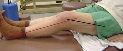 Progressive articulation of the knee joint