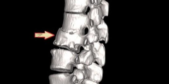 pathology of the spine as a cause of back pain