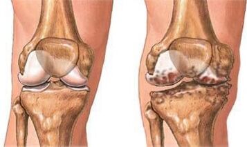 Knee articulation