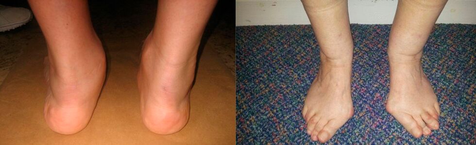Arthritis of the big toe and deforming arthropathy of the ankle