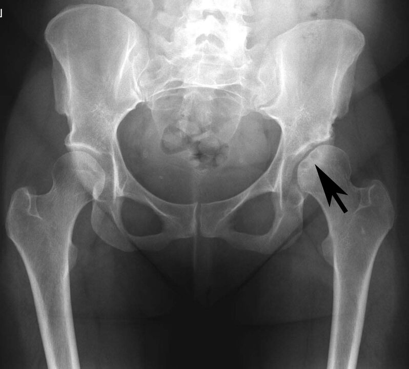 Deposition of calcium salts in the hip joint with pseudo-urinary arthritis on X-ray