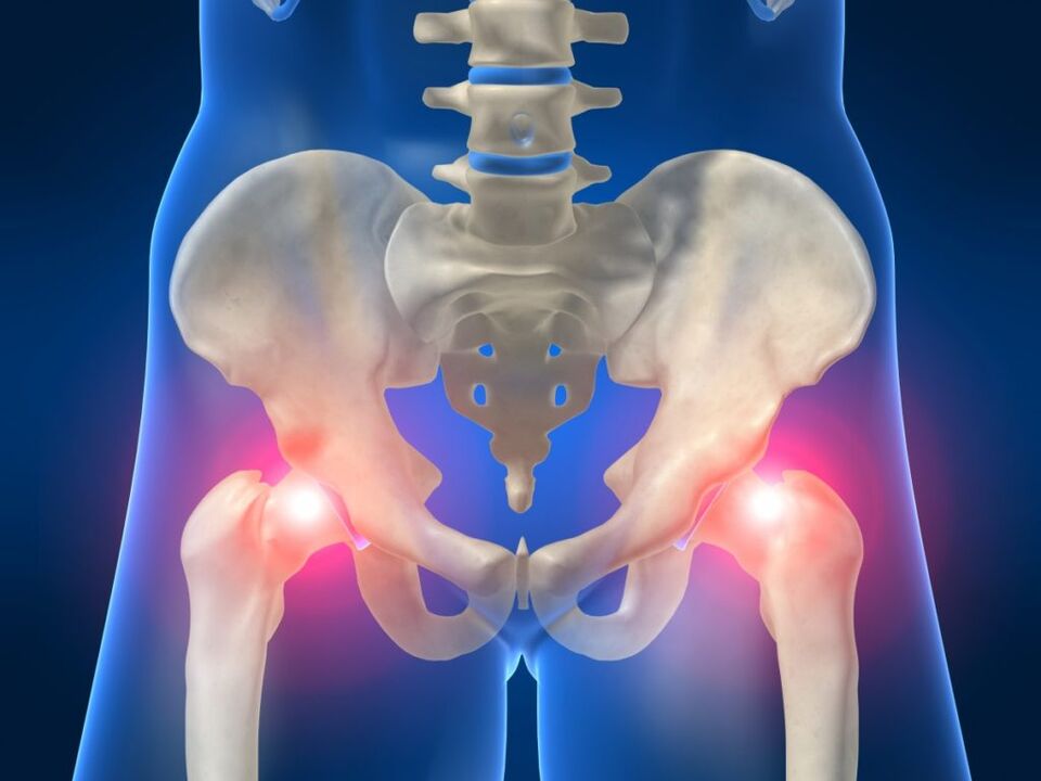 In ankylosing spondylitis, bilateral pain in the hip joint is annoying